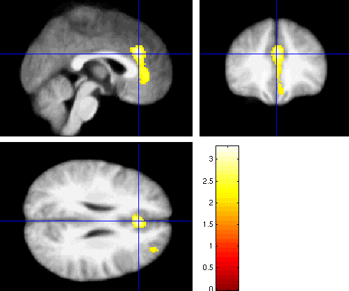(data fusion) ROI/VOI kijelölés Statisztikus parametrikus képfeldolgozás Modellezés Képrekonstrukció Neuronavigáció.