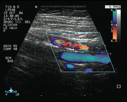 Klinikai vizsgálat Color Doppler (duplex, triplex) főbb mélyvénák