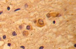 Prion-like disorders (Prion-szerű betegségek) Parkinson-kór Multisystemás