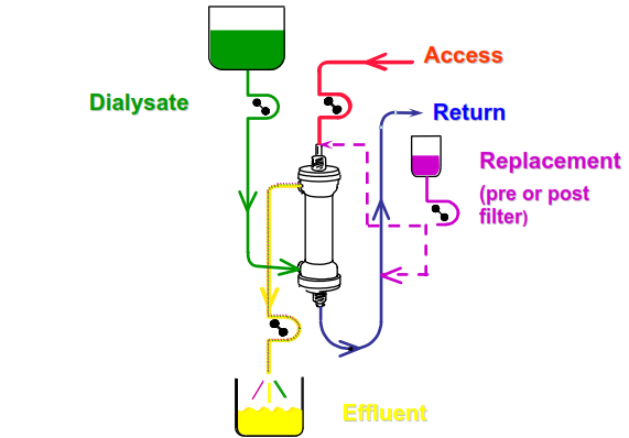 HDF hemodiafiltráció = diffúzió + konvekció Lassú dializátum áramlás ( 15-30 ml/min ) Alacsony vérpumpa fordulat ( 50-200 ml/min ) visszatérő (vénás) szár A filtrátum pótlása (elektrolit, tápanyagok)