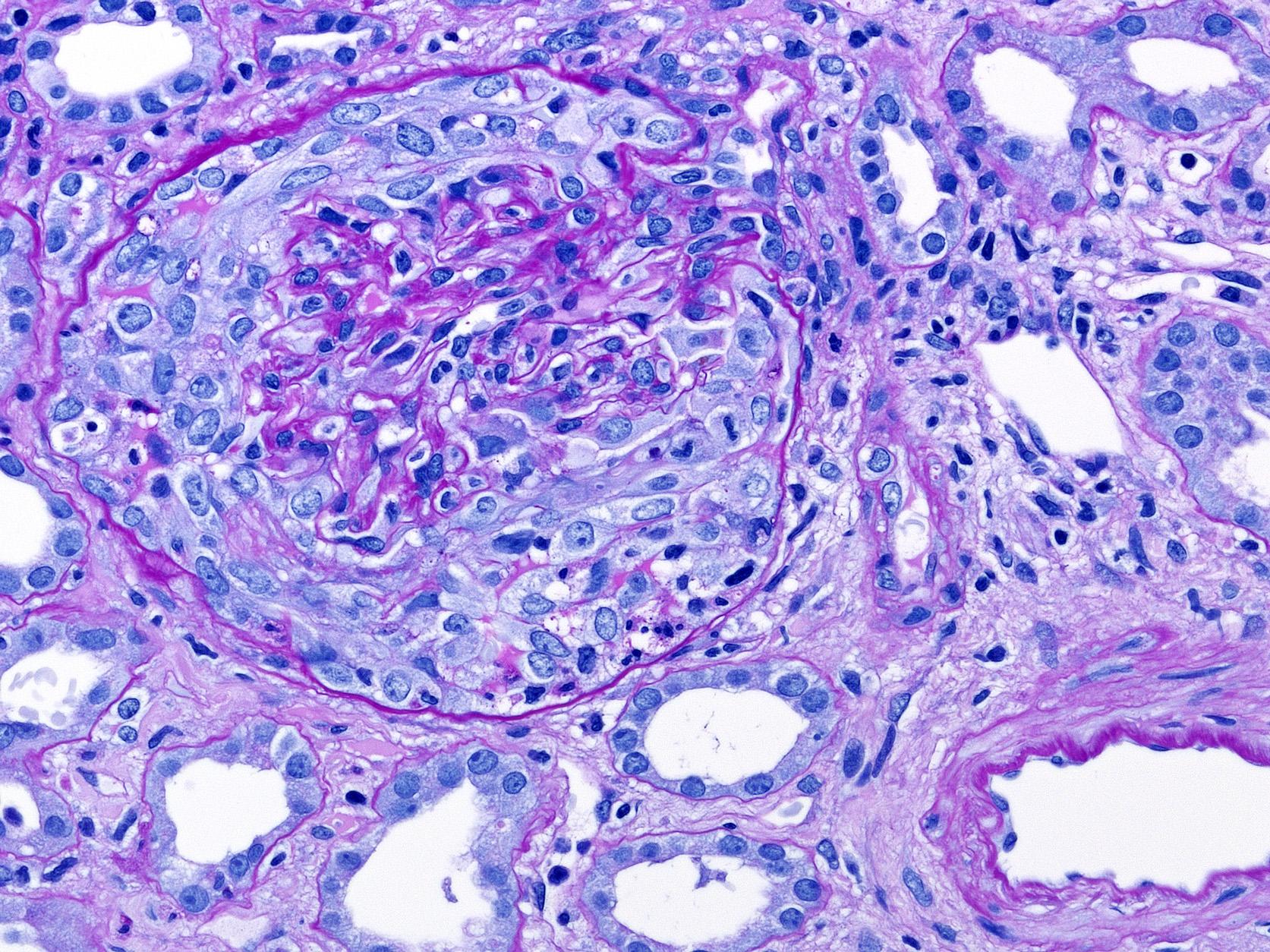 A glomeruluskacsok fibrinoid necrosisa