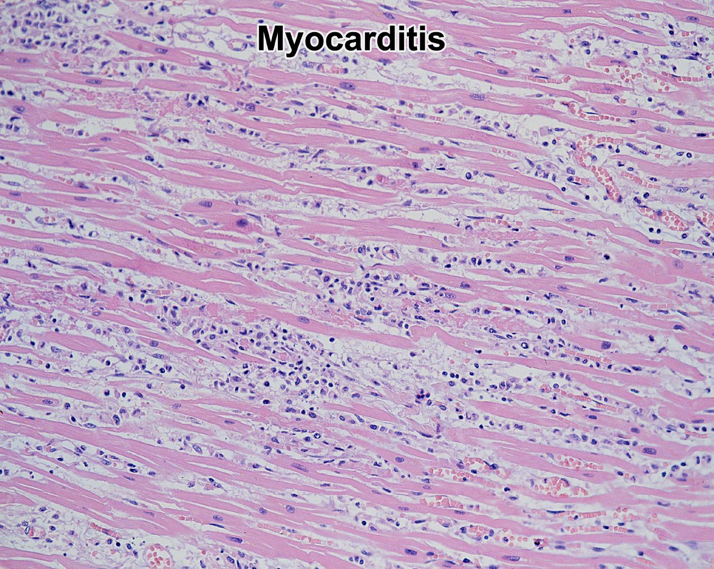 Virális myocarditis: