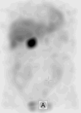 phaeochromocytoma a jobb