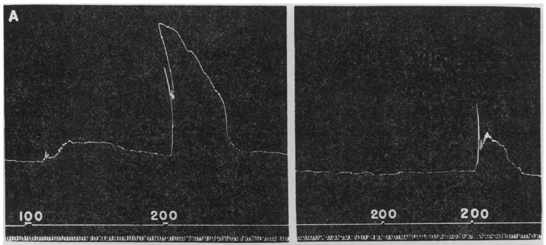 Intraarteriális acetylcholinnal kiváltott izomkontrakció (a.