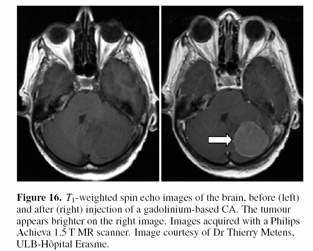 MRI: KONTRASZT Contrast can be caused by differences in proton density ρh. This explains the natural contrast observed on MR images between bones (low ρh) and fat (high ρh), for example.