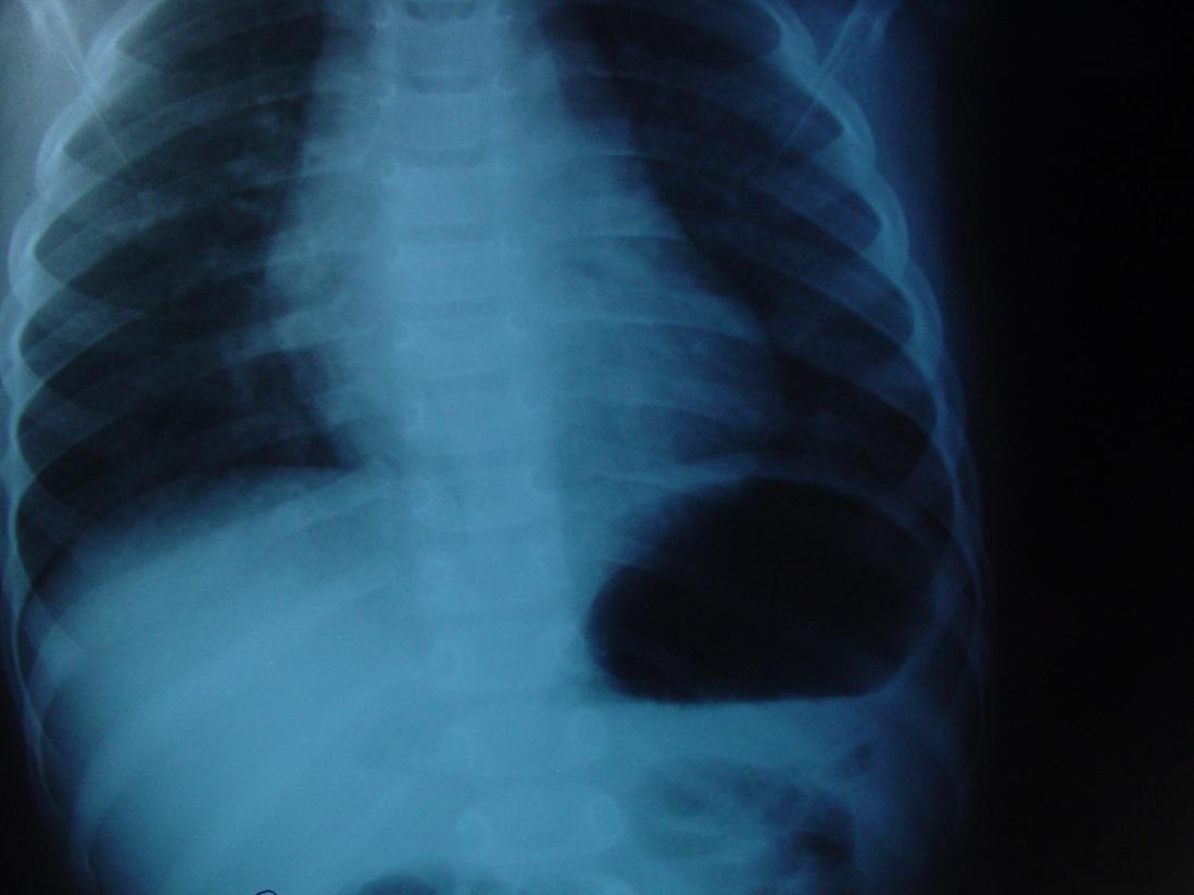 Emphysema idegentest miatt 2; 8 2; 8 1; 4 1; 41; 4 mogyoró 17; 72