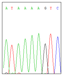 SÚLYOS KOMBINÁLT IMMUNDEFICIENCIA IL2RG gene c.295insa V99fsX11 I. II.