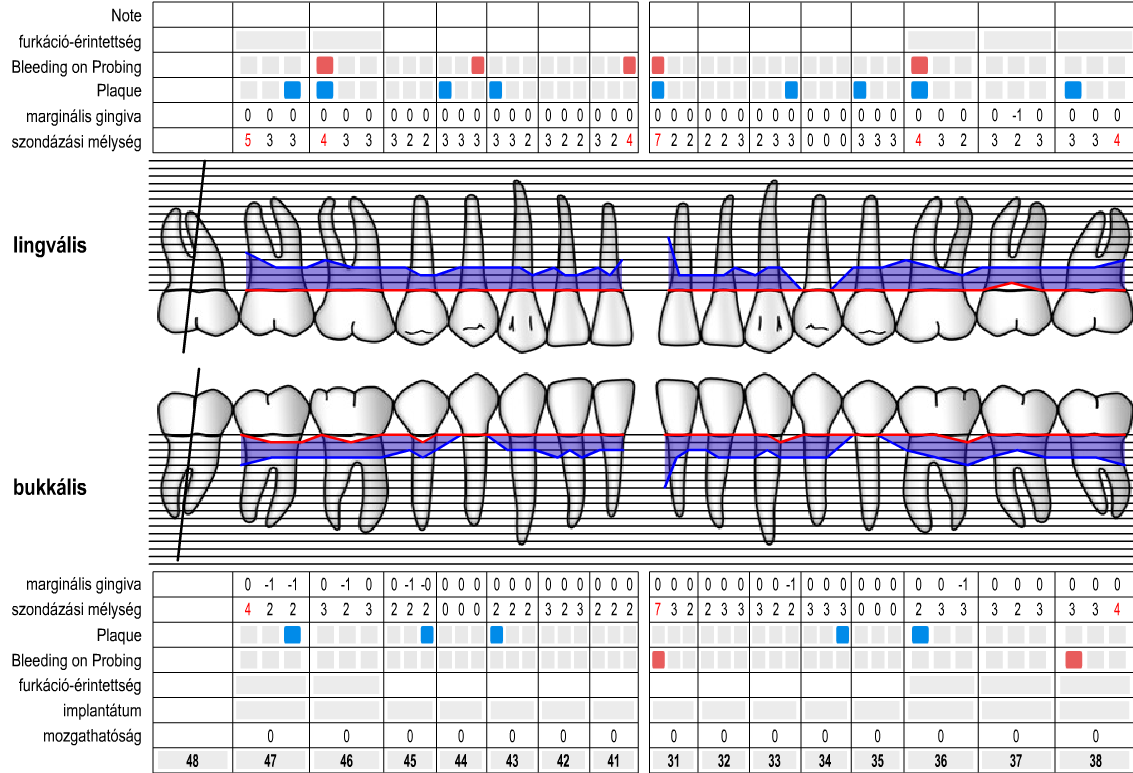 Kiindulási parodontális státusz ( alsó ) Anatómiai okokból 35,44 fogak bukkális felszínein,