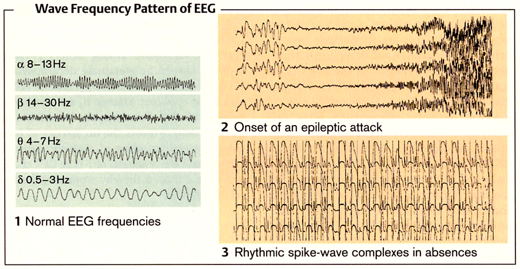 EEG frekvencia mintázatok 1) normális EEG frekvenciák 2) az epilepsziás roham