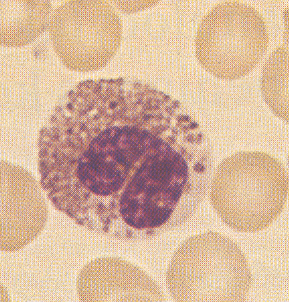 Eosinophil oesophagitis 75% fiú Ételallergia 50%-ban, asztma: 33%-ban Átlagéletkor 11 év (1-17 év) Perif.