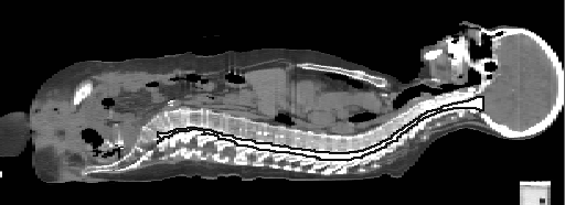 3D CT képek szegmentálása radioterápia tervezéshez Szegmentált