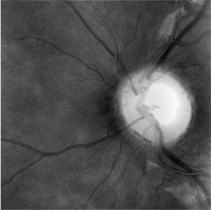 Retina képelemzés betegségek korai felismeréséhez Feladat: Glaukómára utaló