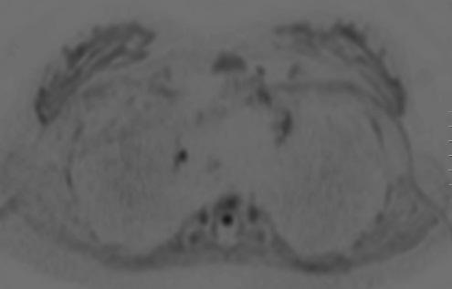 FDG PET-CT