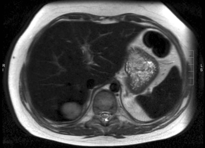 FDG PET-CT fals
