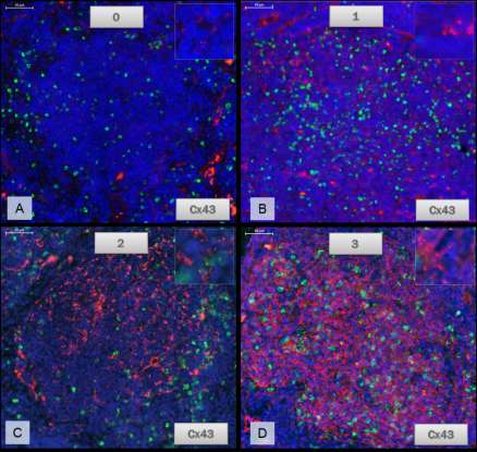 4.3.4. A fluoreszcens immunhisztokémiai metszetek értékelése A Connexin 43 expressziót vizsgáltuk nyirokcsomói lokalizációban, valamint a csontvelői tumoros infiltrátum területén is.