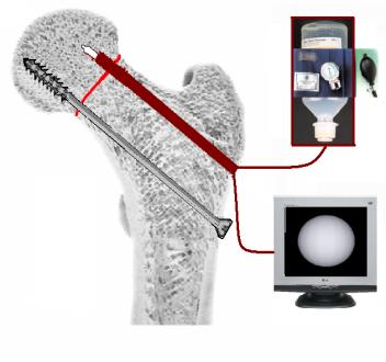 e.) A fúrót eltávolítjuk. f.) A furatot fiziológiás sóoldattal átmossuk. g.) A furatba bevezetjük az osteoscop hüvelyét, szükség szerint újabb mosást végzünk, majd behelyezzük az optikát.