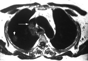 T1-weighted axial MRI demonstrating the primary tumor and