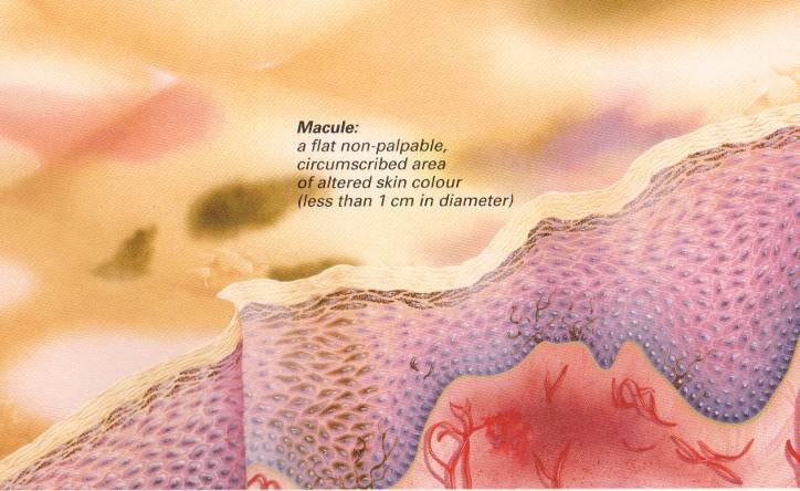 Macula: egyszerű színeltérés (dyscoloration). A bőr szintjében lévő körülírt lézió, mely környezetétől színe révén tér el.