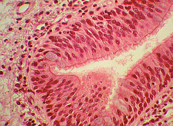 Carcinoma in situ EBUS EndoBronchial UltraSonography