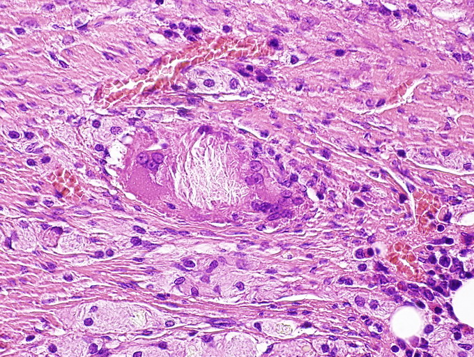 ábra Fibrotikus neostroma habos cytoplasmájú lipophag sejtekkel