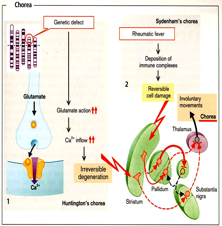 Huntington chorea - A pallidum degenerálódik gyermekkor - huntingtin protein accumulálódik, ami kicsapódik a striatális sejtekben - fokozódik a glutamát neurotoxicitás - hiperkinéziás megbetegedés -