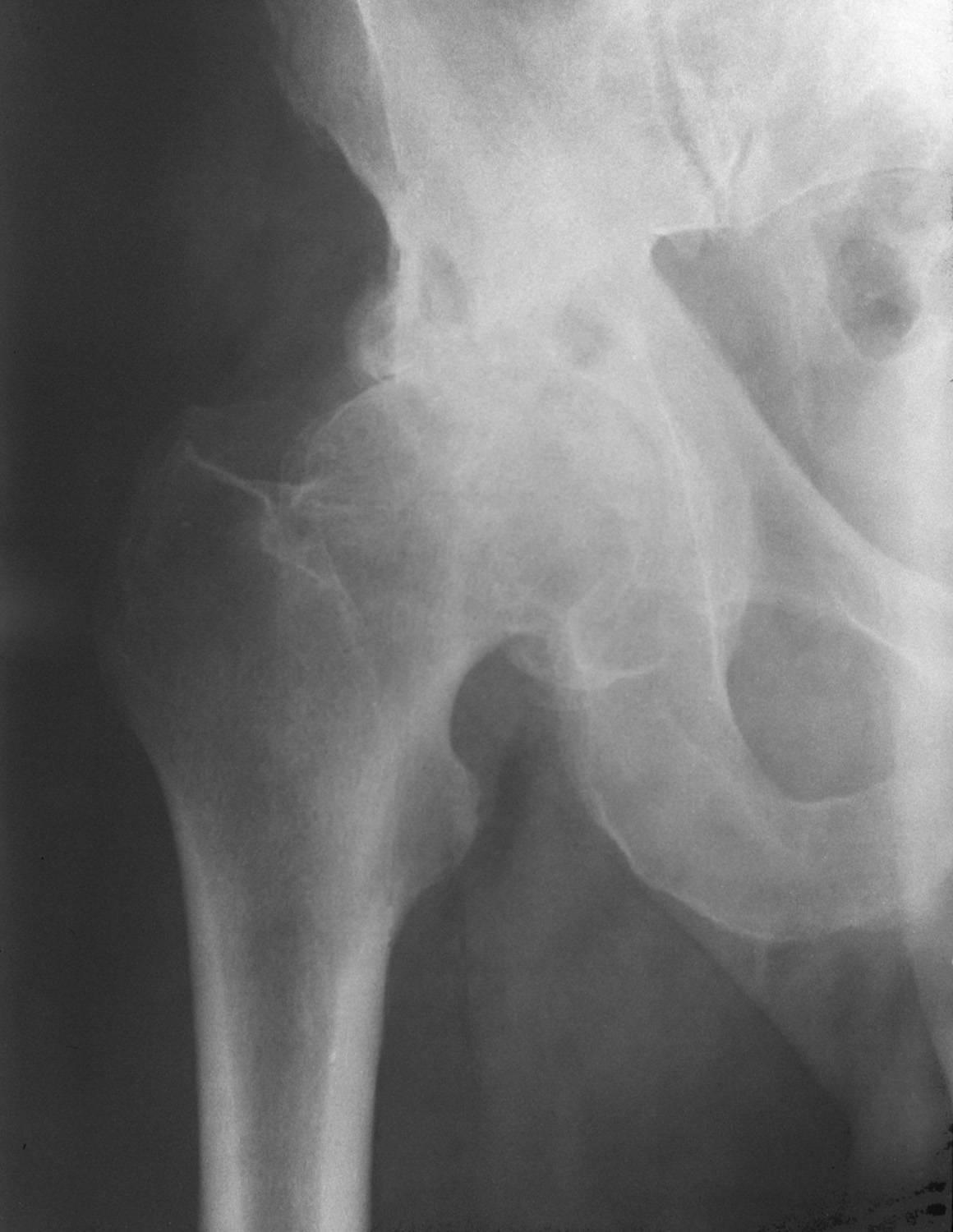 Coxarthrosis: az izületi rés eltűnt, fájdalom,