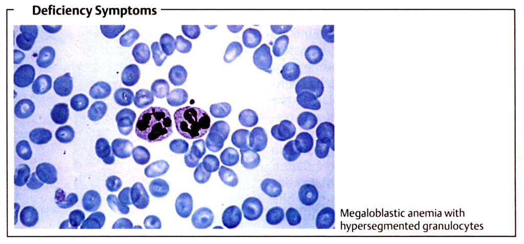 B12 vitamin hiányállapot: megaloblasztos anémia makrocitás, hiperchróm anémia, hiperszegmentált granulociták - folsav hiánynál is kialakul a megaloblasztos anémia, a differenciál diagnózisban