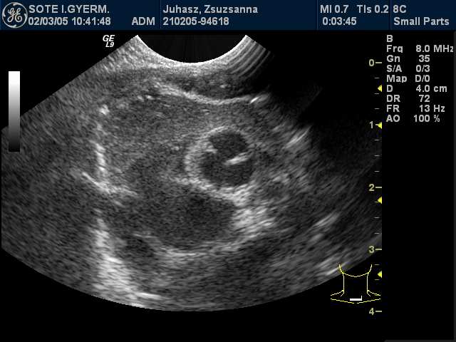 MEDIASTINALIS TERIMÉK THYMUS Normálisan 3 éves korig látható Számtalan