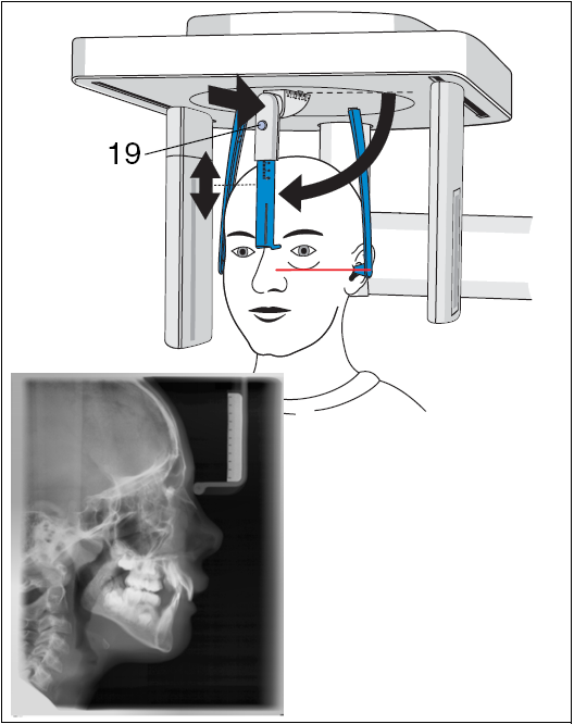 7 Kefalometriás felvételek (Ceph) C3 laterális felvétel (A = aszimmetrikus) Laterális felvétel készítéséhez a páciens arccal előre nézzen. Helyezze be a füldugókat a külső hallójáratba.