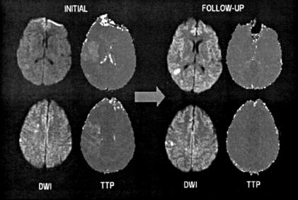 DeLaPaz, AJNR 2007: 1197-99 Definíció: TIA Javaslat új definícióra: rövid neurológiai működészavar feltehetően focalis agyi vagy retina ischaemia miatt, amely rendszerint 1 óránál rövidebb ideig tart