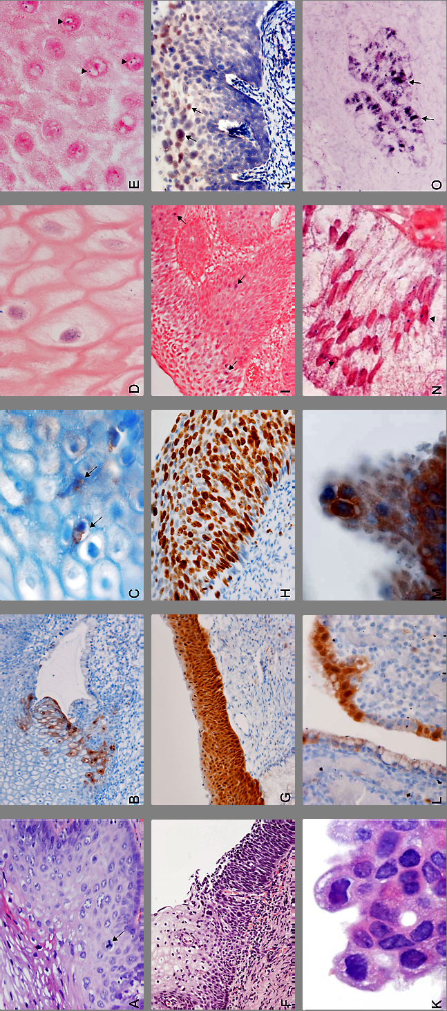 1. ábra HPV indukált hámelváltozások és sejtcikluszavarok hisztomorfológiája A) A HPV fertőzés nem klasszikus citológiai jelei hiperpláziás cervixhámban [parakeratózis és szuprabazális mitózis]
