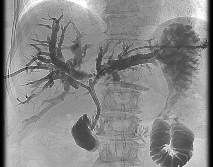 Az obstrukciós icterus perioperatív ellátása Külső drainage: Cholangitisben