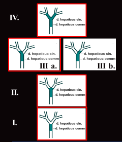 Hiláris epeúti tumor/klatskin