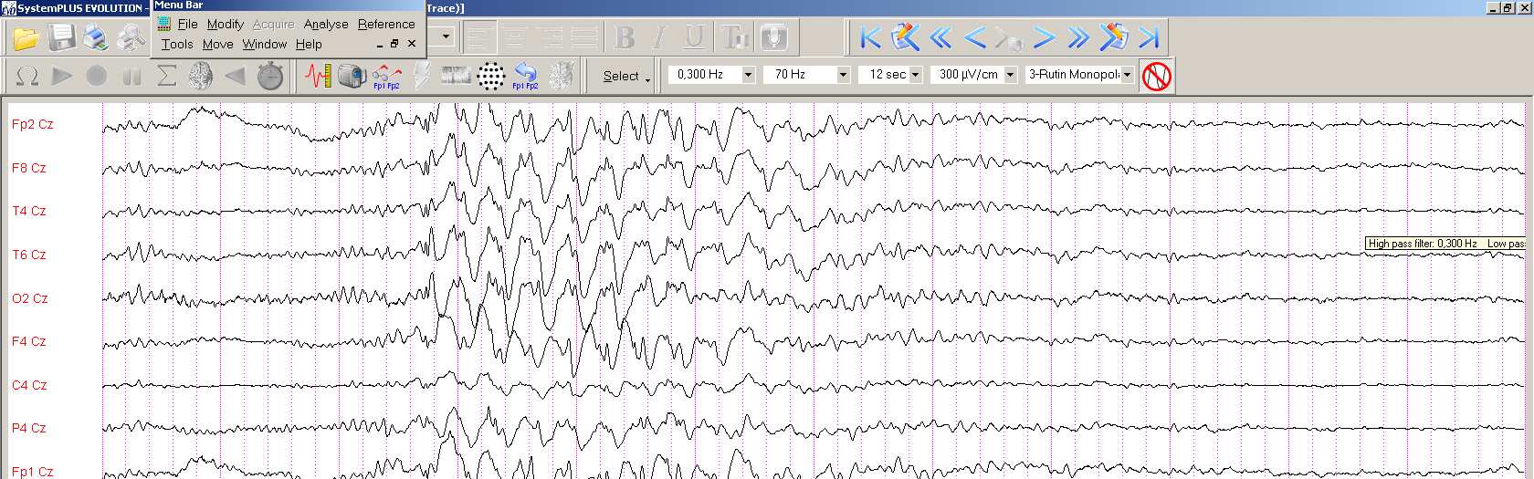 ABSENCE EPILEPSZIA EEG: ii: SWK (3/sec), generalzált ÉLETKOR: 4-8ék OK: genetikai