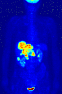 Milyen esetekben javasolt a PET-CT vizsgálat?