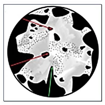 2. ábra A TNI (Tumor Thickness at the Tumor-Normal Interface) meghatározása Maru és mtsai által.