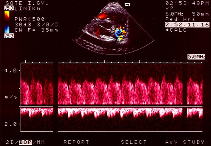 PDA II.