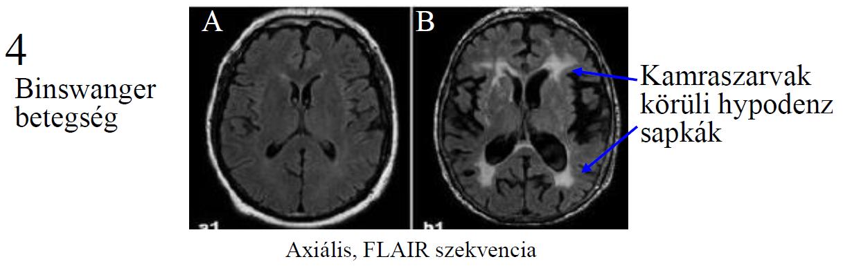 Radiológiailag: CT-vizsgálattal kétoldali leukoaraiosis, vagy MR vizsgálattal kétoldali és