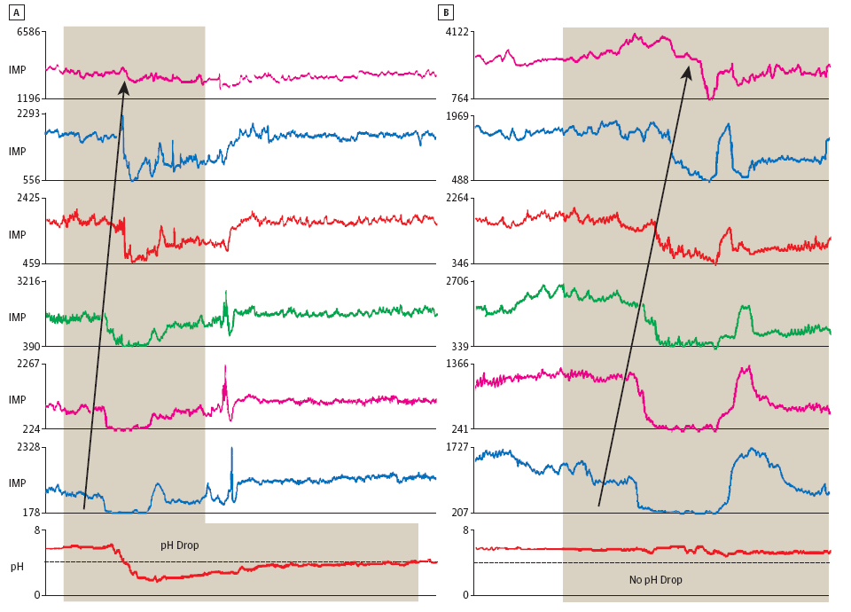 ph-mii Rosen R: Gastroesophageal Reflux in Infants More Than Just a phenomenon JAMA Pediatr.