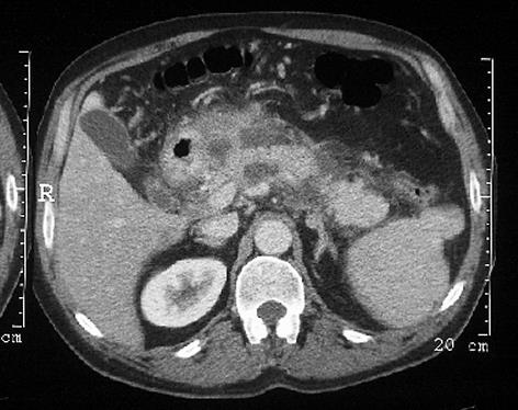 Acut pancreatitis Hol van folyadék?