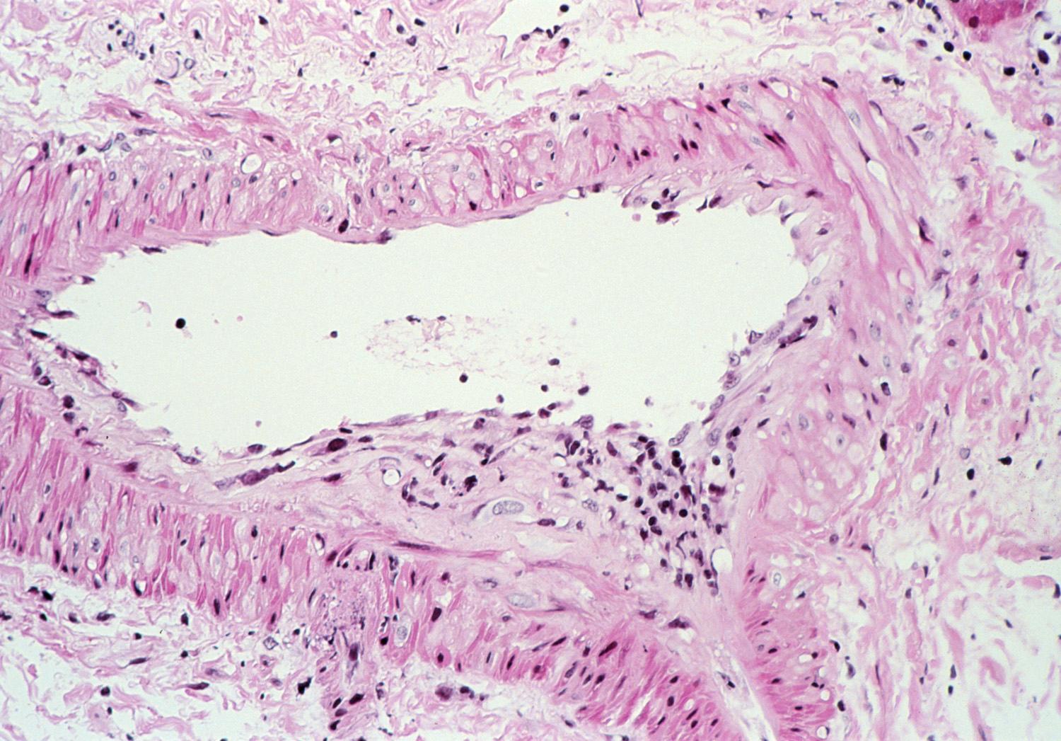 Intimális arteritis: