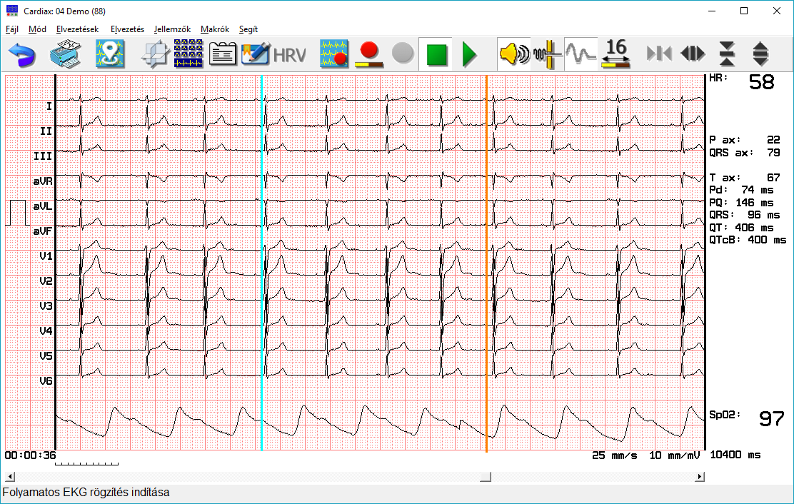 Cardiax. számítógépes EKG. felhasználói leírás 2016, 4.4 kiadás. Gyártó:  IMED Kft Budapest, Etele út Tel./Fax: - PDF Free Download