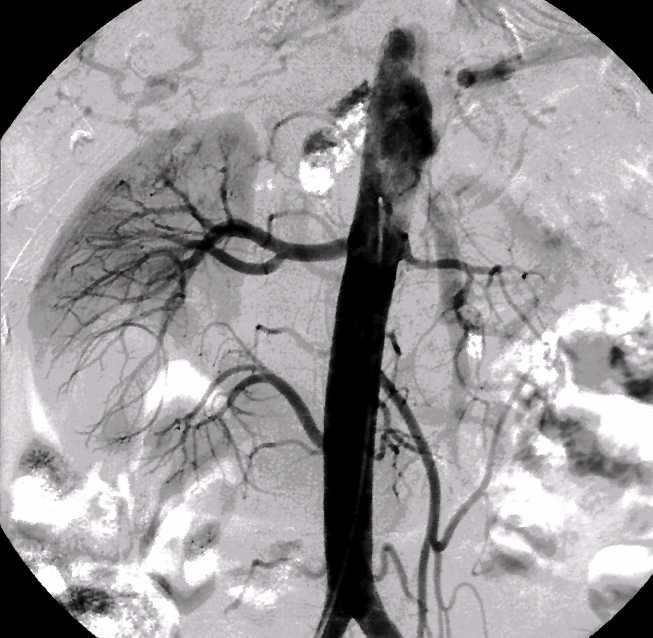 Artériás rendszer: ALSÓ TESTFÉL Az alsó testfelet az aorta descendens (leszálló aorta) rekesz alatti része: az aorta abdominalis (hasi fıverıér) látja el O2 dús vérrel.