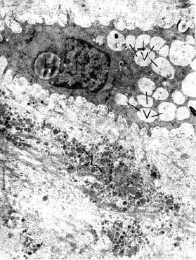 11 7. ábra. Degenerált fibrocyta és a környező stroma négyéves kísérleti praeparatum neointimájában (direkt nagyítás 4.150 x, össznagyítás 12.450 x) (BG anyagából) L= zsírcsepp. N=nucleus.