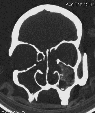 inhomogén anyag (10. a. b. ábra). Mindkét sinus maxillaris medialis fala a középsőorrjáratok szintjében hiányzik (post mortem). a. b. 10. a. b. ábra. Szent László koponya CT-felvételén jól látható a bal arcüregben meszet, vagy fémet tartalmazó gombafonal massza maradványa.