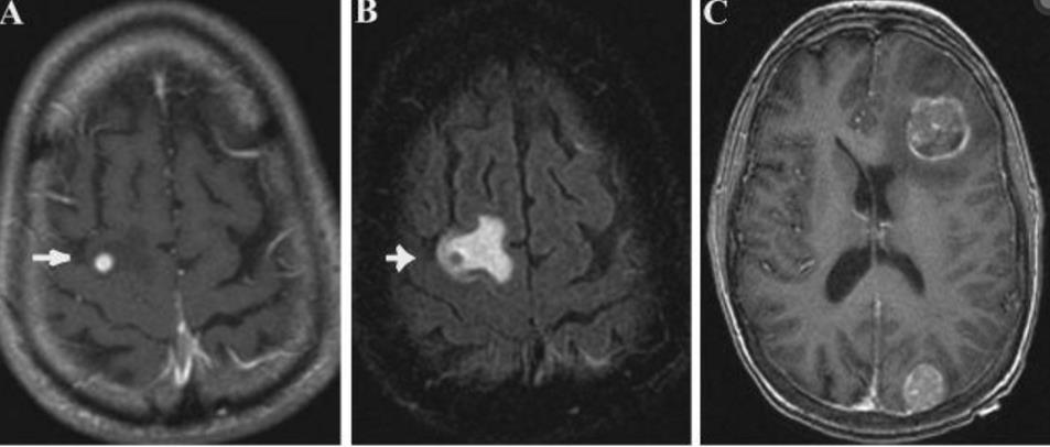 Alternatív bevitel jövőbeli lehetősége CNS metasztázis esetén? A MAB-ok sérült vér-agy gáton jutnak át, de mi van CNS metasztázis esetén intakt vér-agy gát esetén?