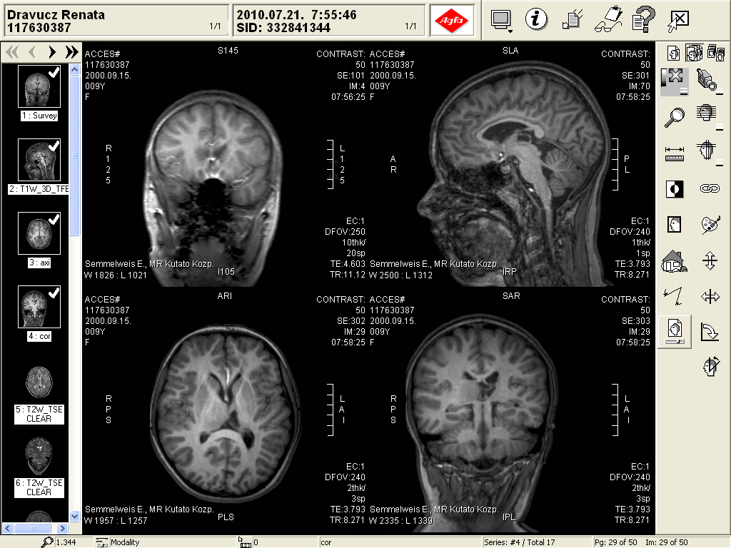 ábra Bal oldali izolált thalamus lézió (A), illetve bal thalamus lézió plusz periventricularis leukomalatia (B) az ESES szindróma hátterében.