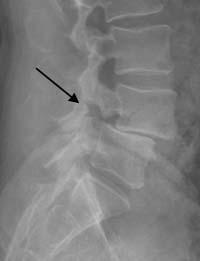 Spondylolysis, spondylolisthesis: Feltételezések szerint, lehetnek fejlődési rendellenességek, de a gyermekkori traumák is nagymértékben szerepet játszanak a kialakulásában.