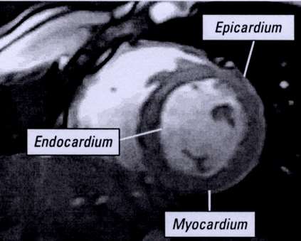 Basal and Middle Apical Regional left ventricular function Left ventricle: 17 segment Apex Wall thickening = 100*(Ds-Dd) / Dd 6 6 segments inferoseptal anteroseptal anterior anterolateral
