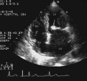 A4C Dilatált LA LA és LA appendage thrombus Paradox